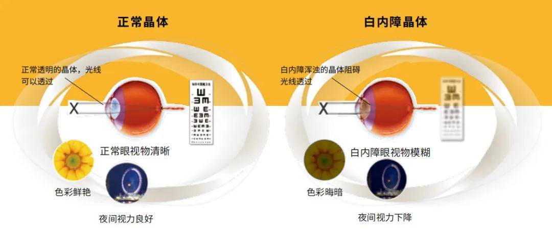 玻璃體混濁最新特效藥，突破與創(chuàng)新的治療策略